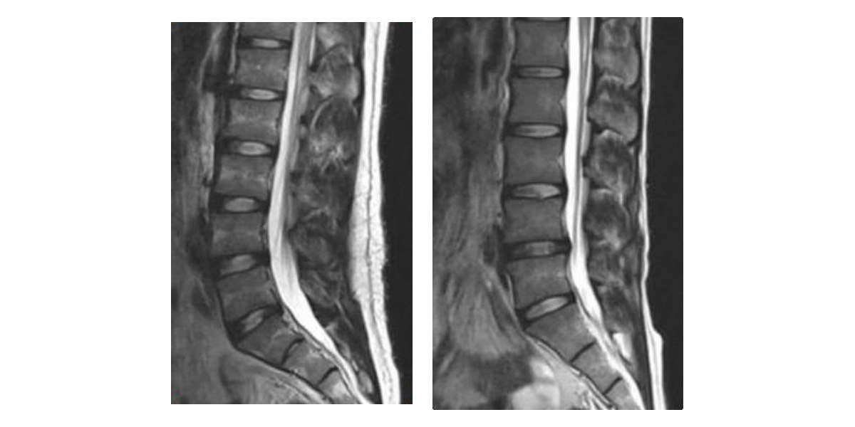 허리 MRI 옆모습 둘 — 왼쪽은 정상 허리의 앞으로 볼록한 곡선, 오른쪽은 곡선이 사라져 곧게 선 일자 허리
