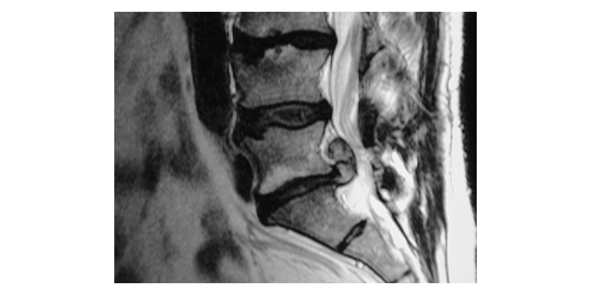 허리 MRI 옆모습(왼쪽이 배 쪽) — 척추뼈 사이의 디스크 하나가 뒤쪽으로 둥글게 튀어나와, 신경이 지나는 흰 척추관 쪽으로 밀고 들어간 모습